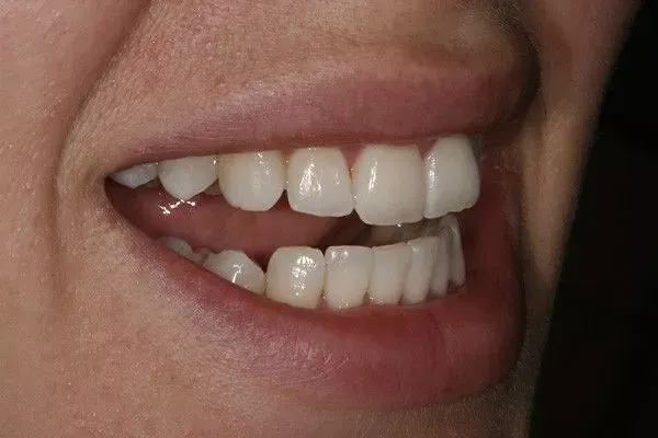 Patient case 1: after treatment at Caspian Dental Clinic