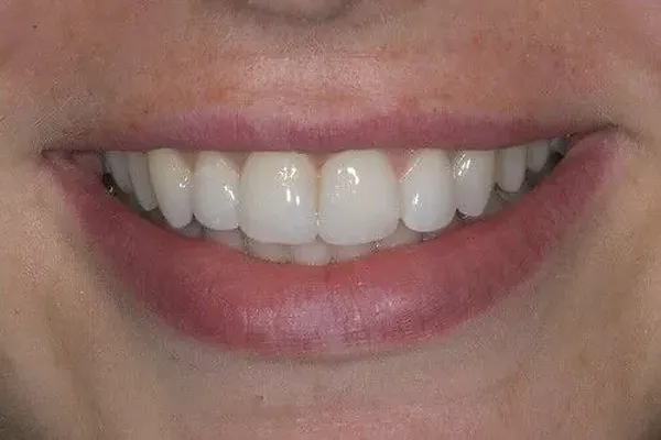 Patient case 2: after treatment at Caspian Dental Clinic