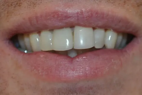 Patient case 3: after treatment at Caspian Dental Clinic