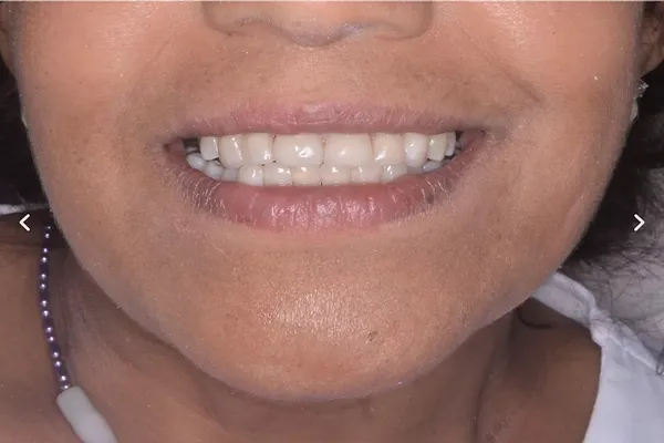 Patient case 4: after treatment at Caspian Dental Clinic